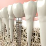 The Risks of Infection After Getting Dental Implants