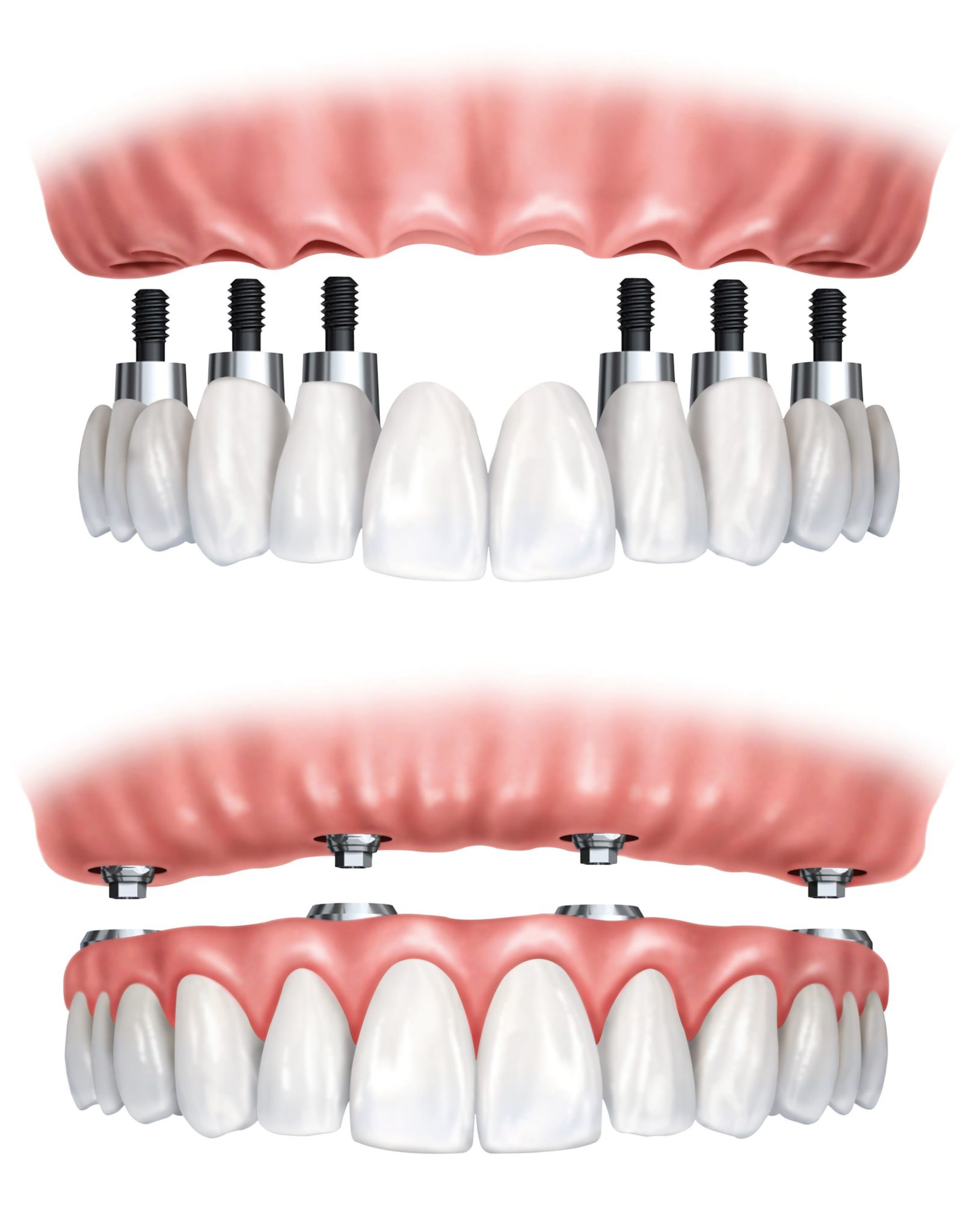 Lacking Jaw Bone? – All On 4 Dental Implants