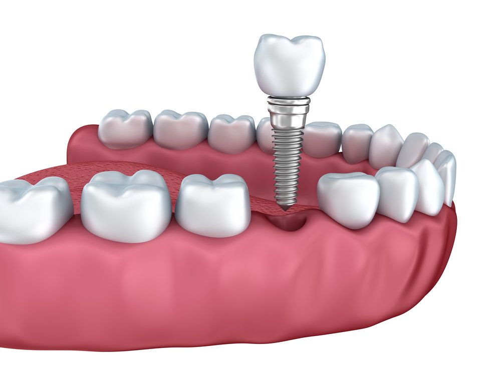 Dental Implant Surgery and Pain