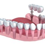 Multiple Tooth Replacement with Dental Implants
