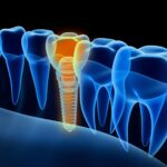 Dental Implant and Osseointegration Success Tips