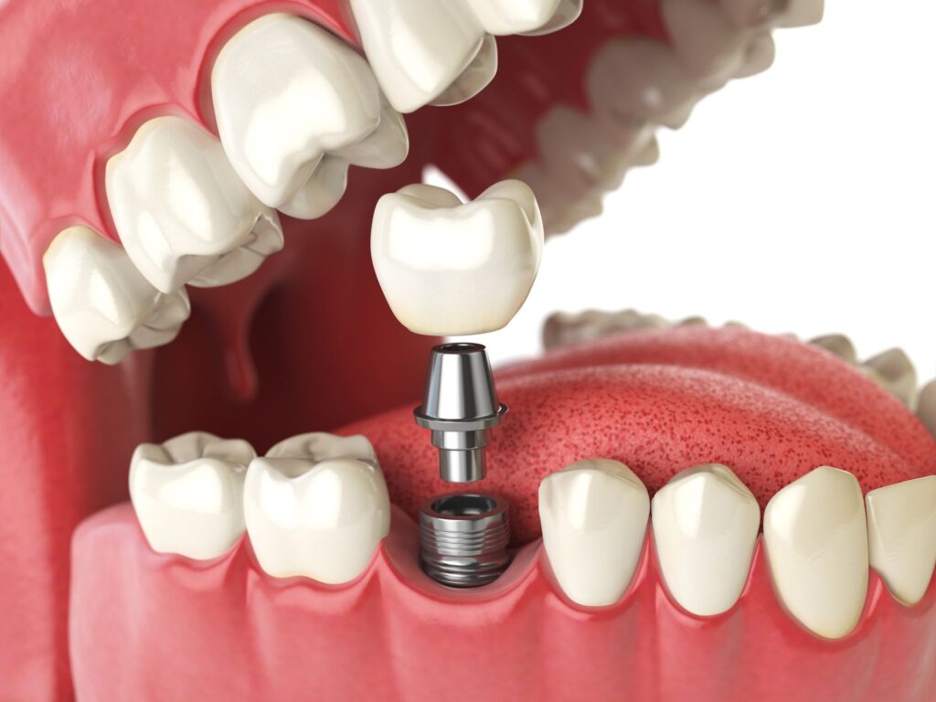 The of History of Dental Implants