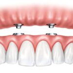 Are You a Good Candidate for All-on-4<sup>®</sup> Implant-supported Dentures?