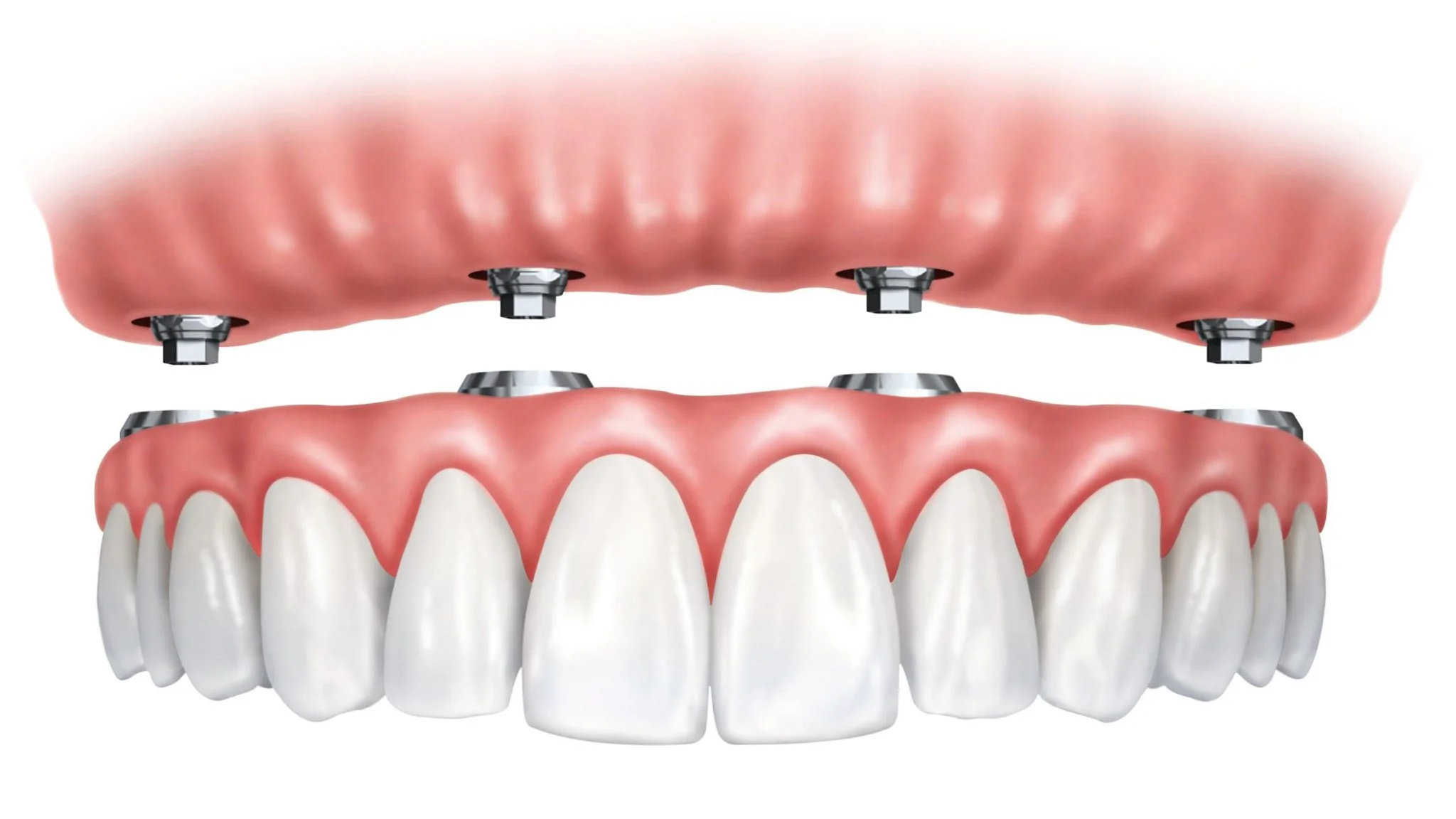 All on 4 Dentures