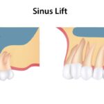 Lifting Low Sinuses for Dental Implant Treatment