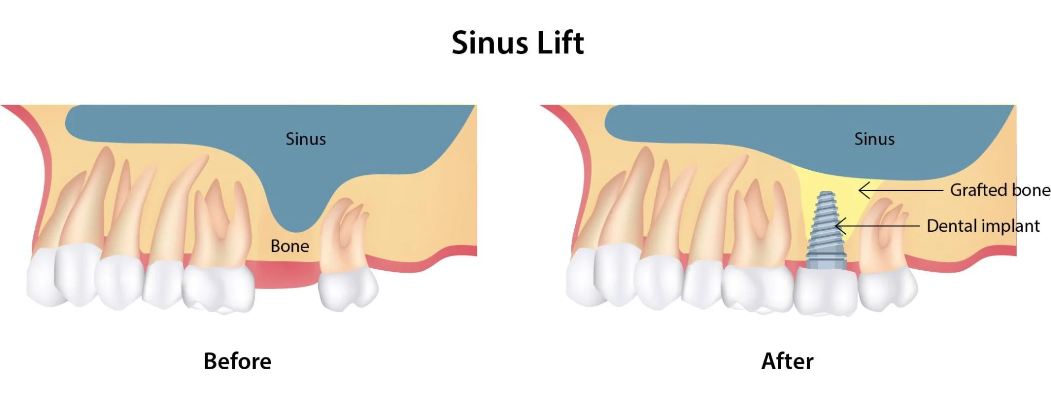 Can Dental Implants Affect Sinuses?