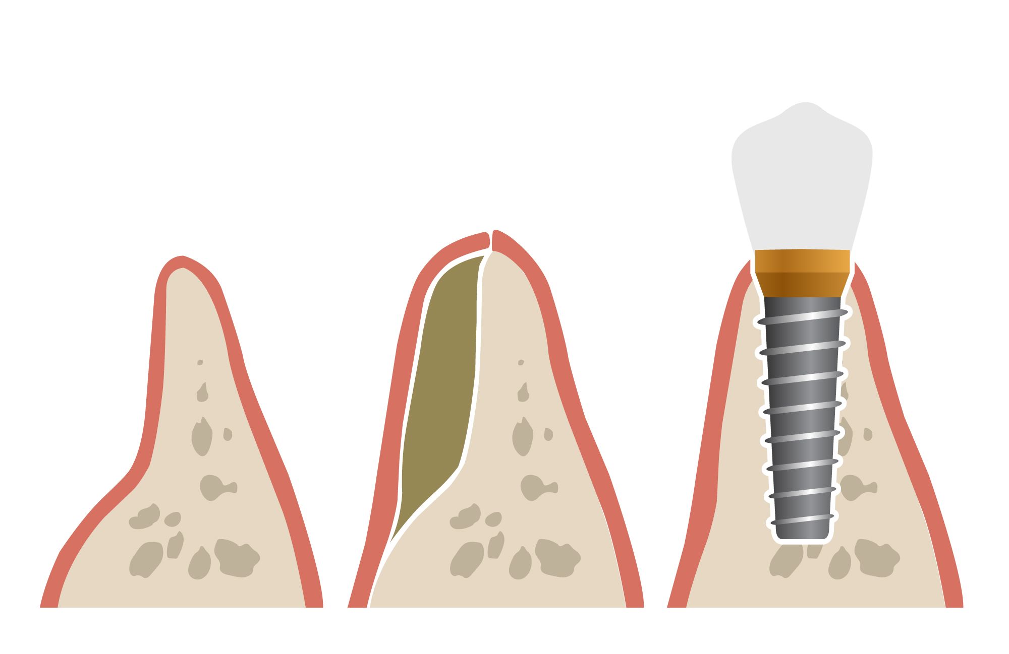 Восстановление костной ткани зубов. Пластика кости при имплантации. Костная пластика альвеолярного отростка. Костная аугментация челюсти.