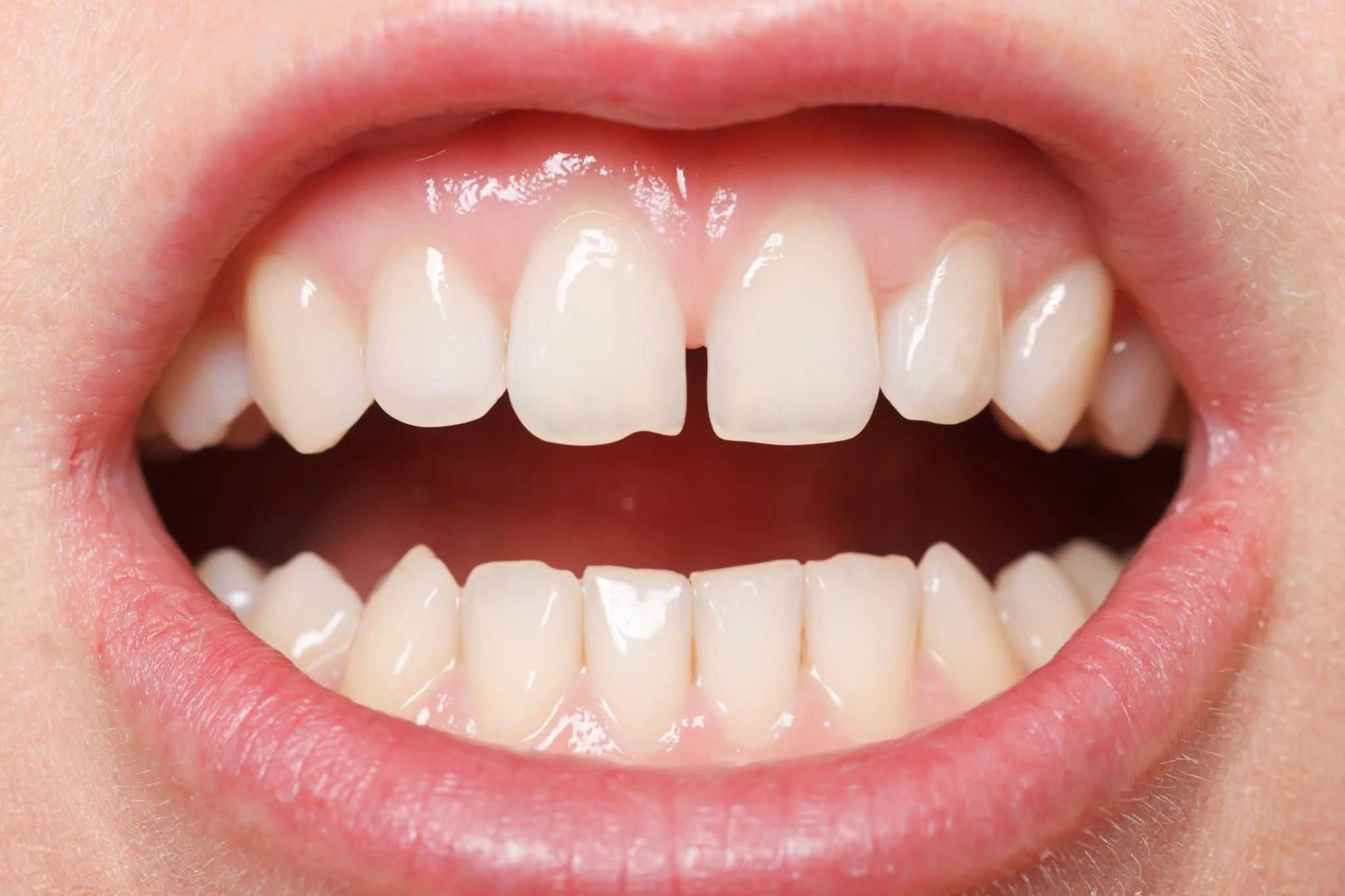 We Can Fix That Smile Treatments For Chipped Teeth