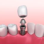 Dental Implants and Socket Preservation – Jackson, MS