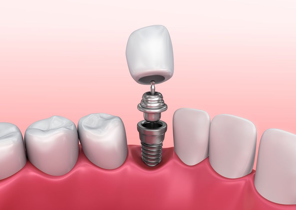 Dental Implants and Socket Preservation Jackson, MS