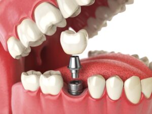 Dental Implants for Missing Molars: What Patients Should Know