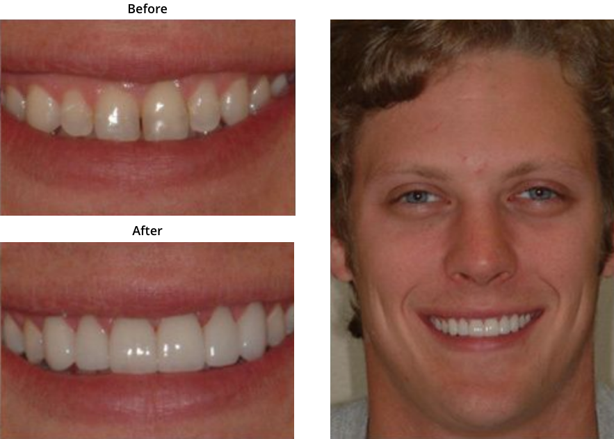 Porcelain Dental Veneers Jackson MS