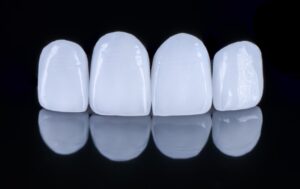 model teeth, 4 porcelain veneer teeth