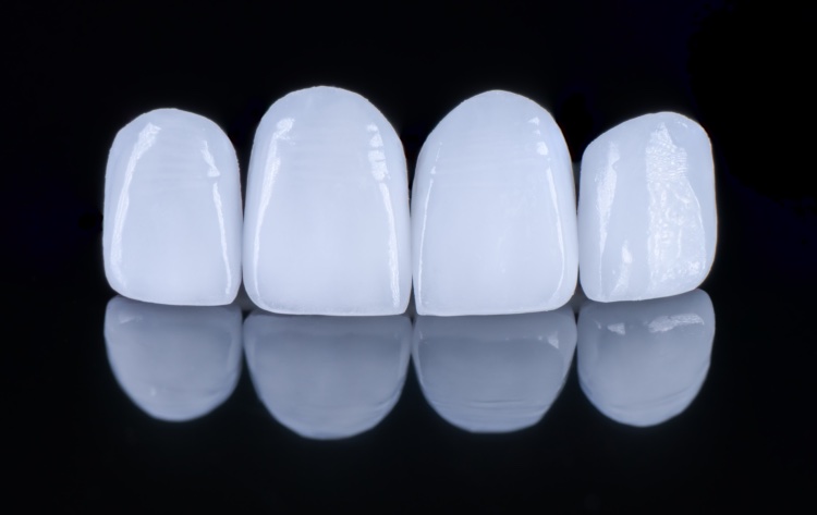 model teeth, 4 porcelain veneer teeth
